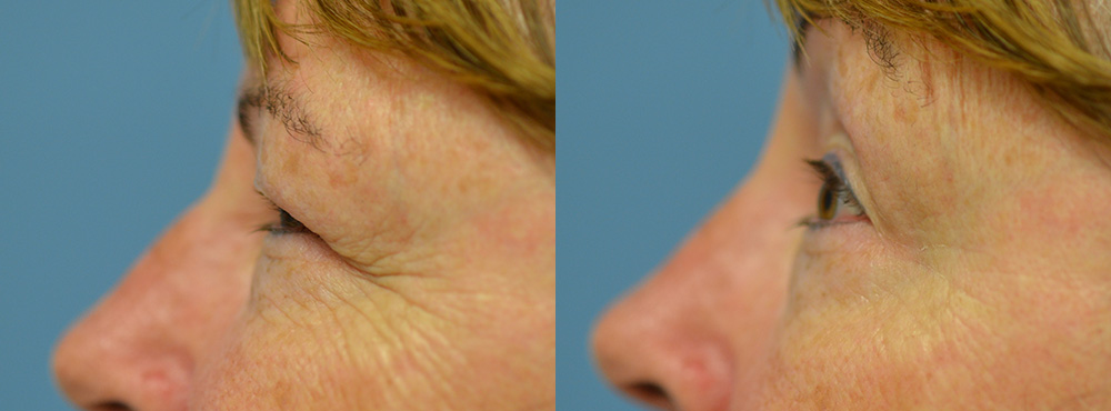 Blepharoplasty Before and After