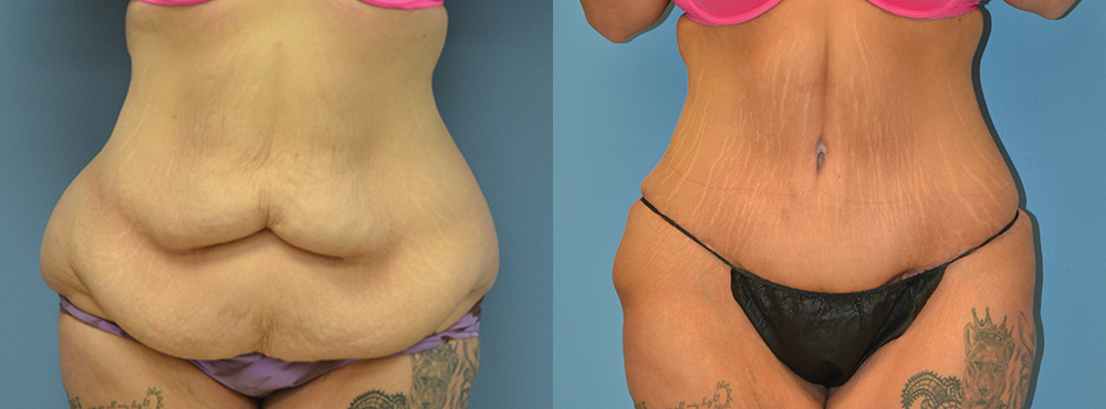 Tummy Tuck Before and After