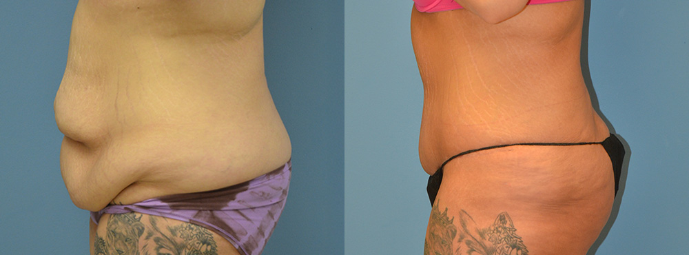 Tummy Tuck Before and After