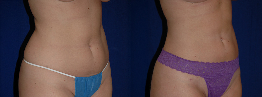 Liposuction Before and After