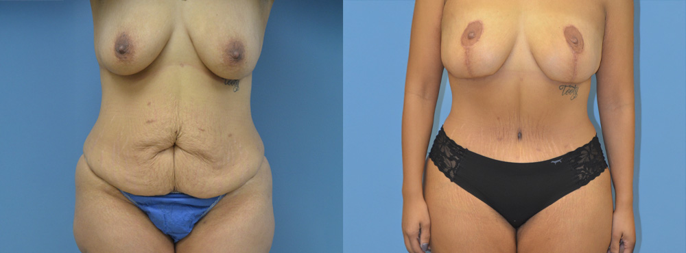 Mommy Makeover Before and After