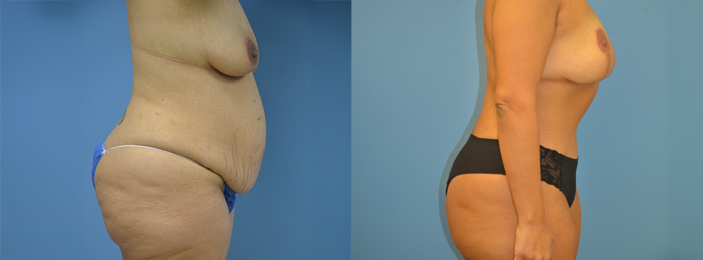 Mommy Makeover Before and After