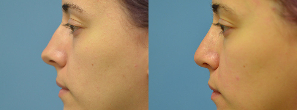 Rhinoplasty Before and After