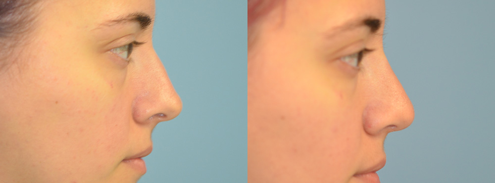 Rhinoplasty Before and After