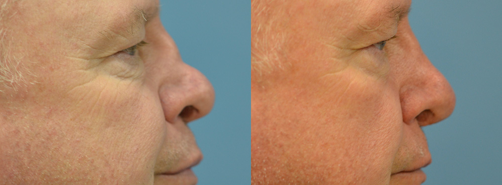 Rhinoplasty Before and After