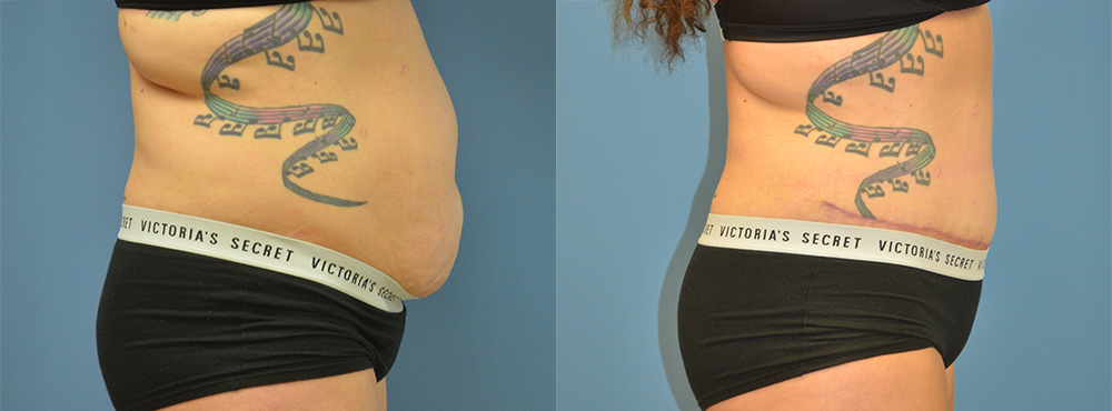 Tummy Tuck Before and After