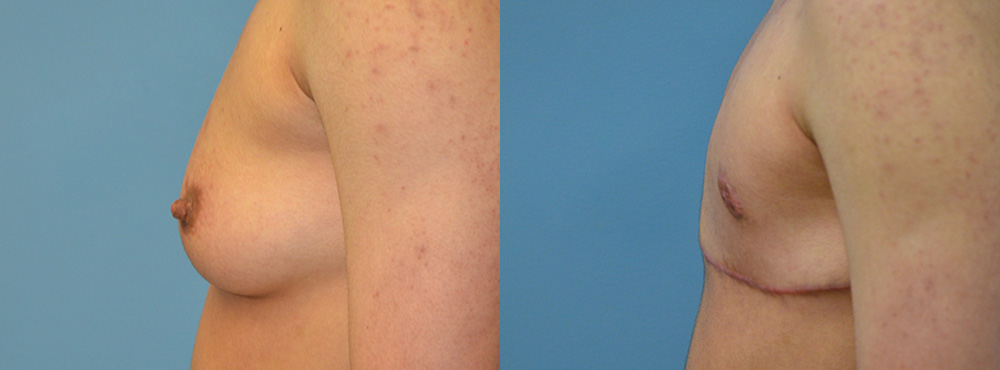 Mastectomy Before and After