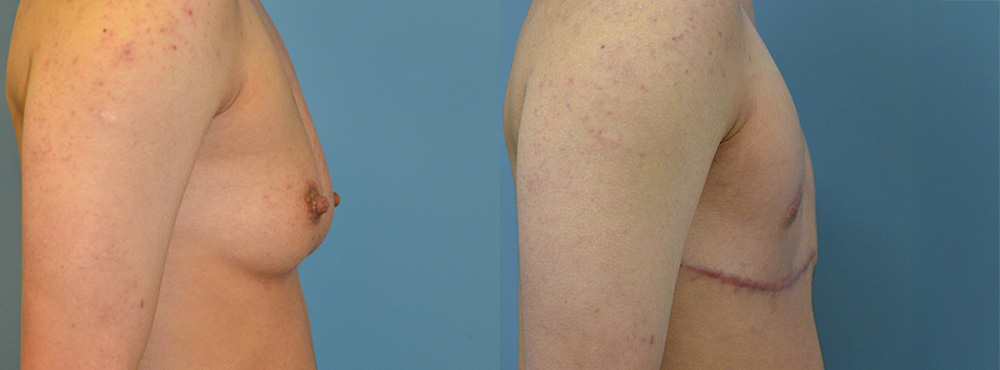 Mastectomy Before and After