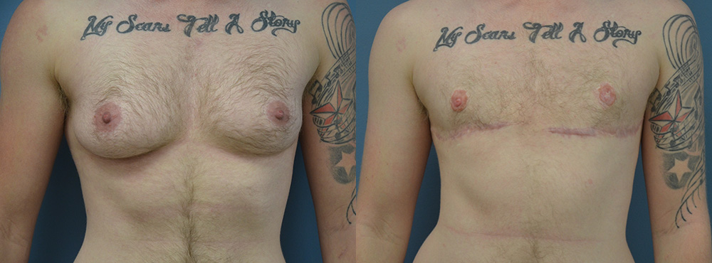Mastectomy  Before and After
