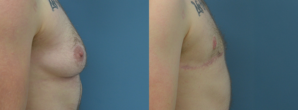 Mastectomy  Before and After