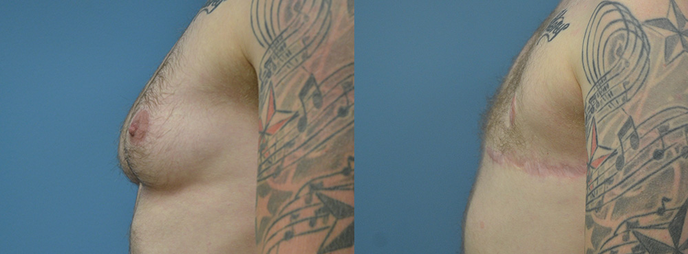 Mastectomy  Before and After