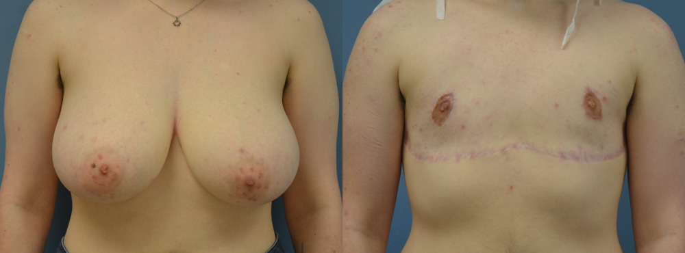 Mastectomy Before and After