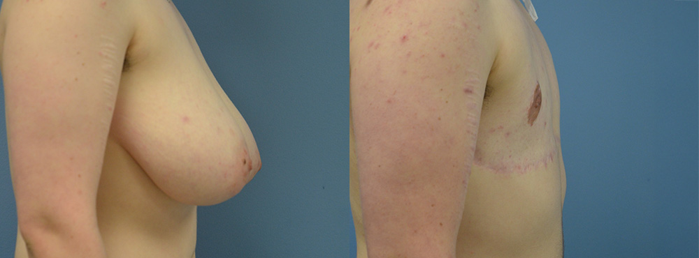 Mastectomy Before and After