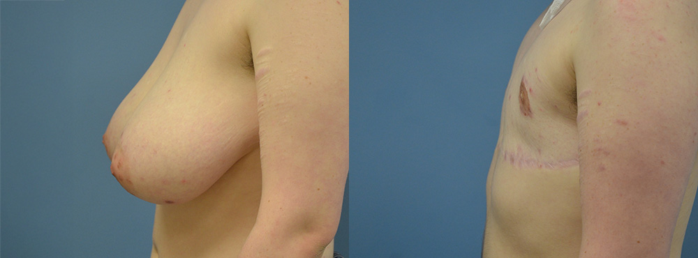 Mastectomy Before and After