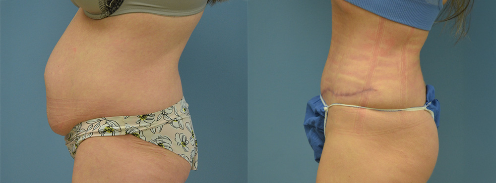 Tummy Tuck Before and After