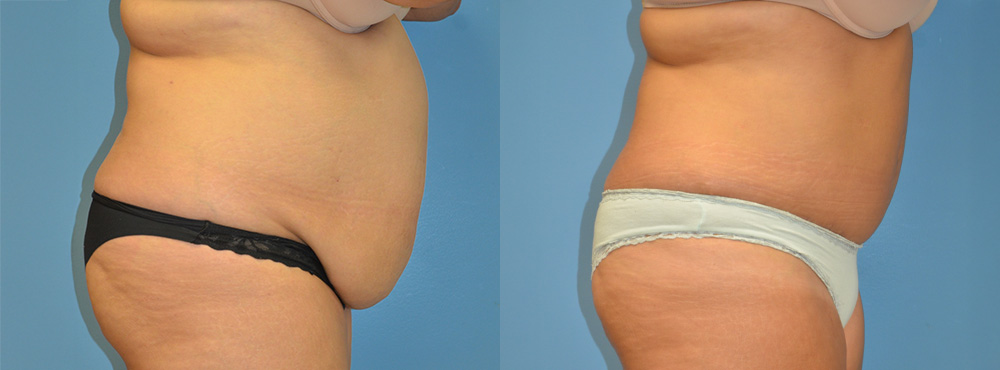 Tummy Tuck Before and After