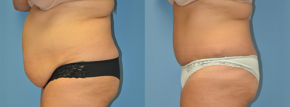 Tummy Tuck Before and After