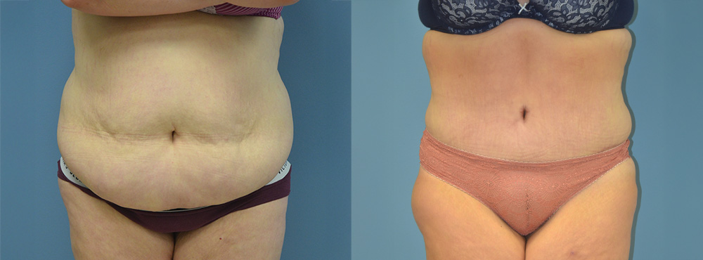 Tummy Before and After