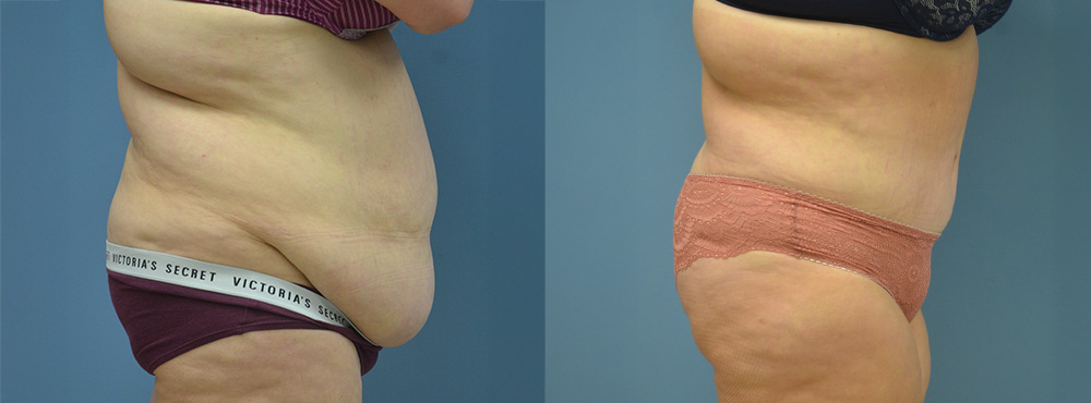 Tummy Before and After