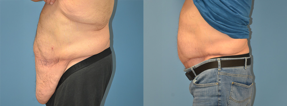 Tummy Tuck Before and After