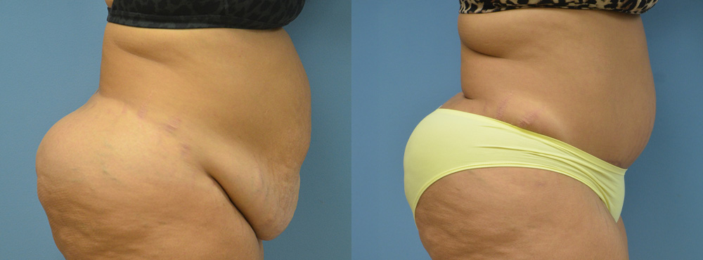 Tummy Before and After