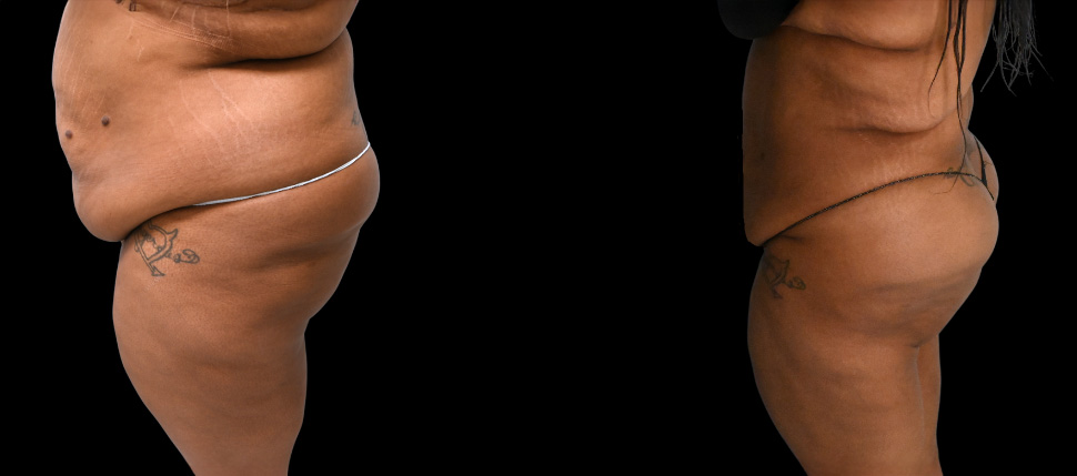 High BMI Lipo Before and After
