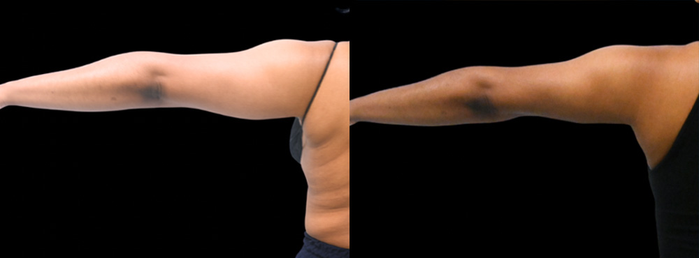 Arm Lift Before and After