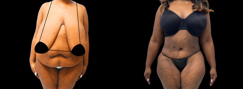 Mommy Makeover Before and After