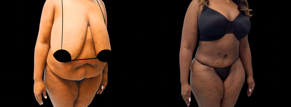 Mommy Makeover Before and After