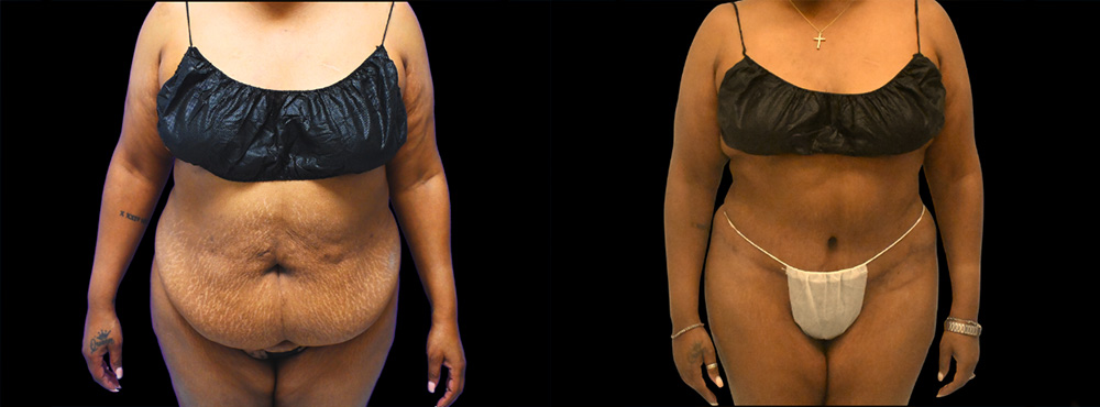 Tummy Tuck Before and After