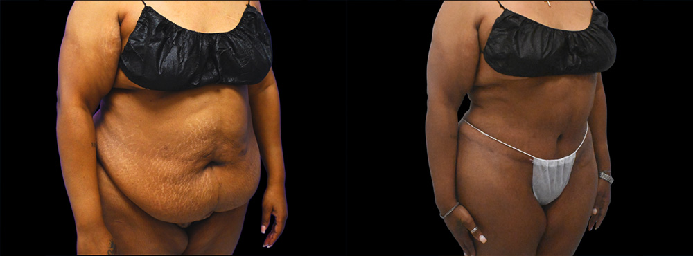 Tummy Tuck Before and After