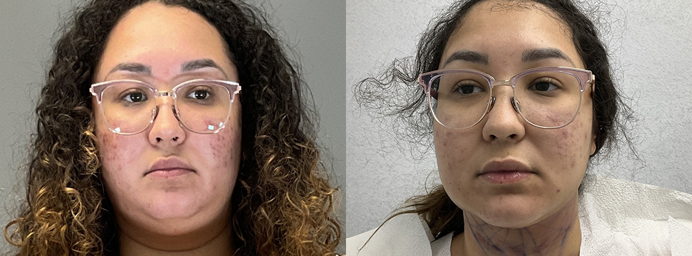 Chin Lipo Before and After