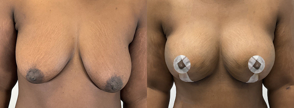 Breast Lift Before and After