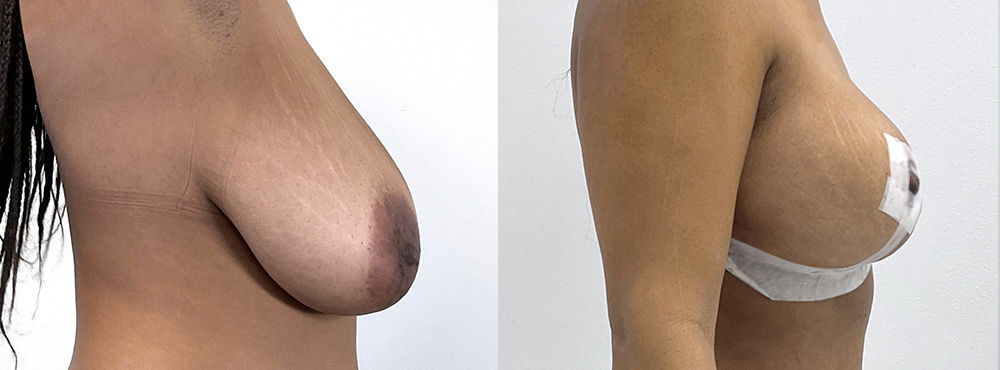 Breast Lift  Before and After