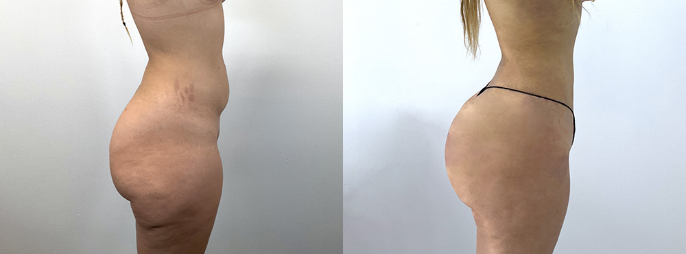 BBL Before and After