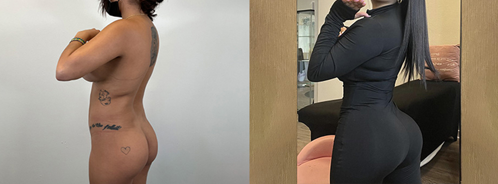 Brazilian Butt Lift Before and After
