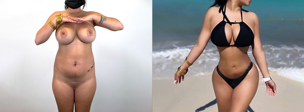 Brazilian Butt Lift Before and After