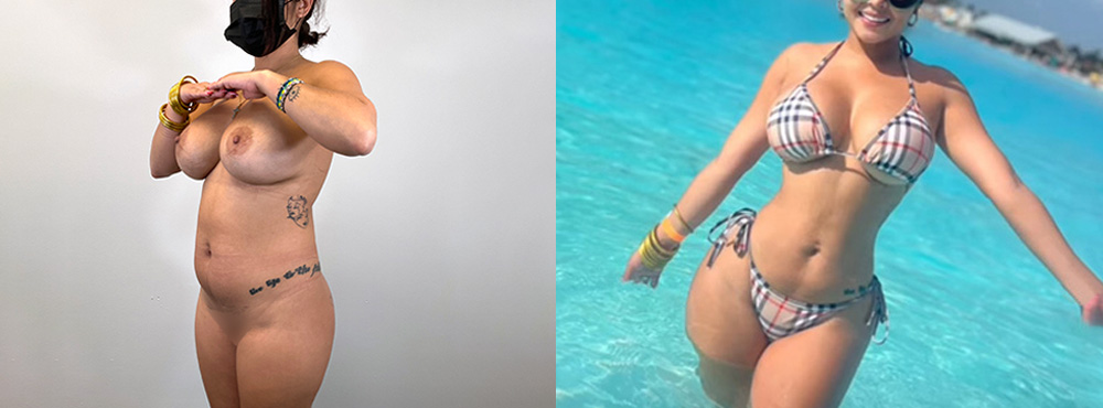 Brazilian Butt Lift Before and After