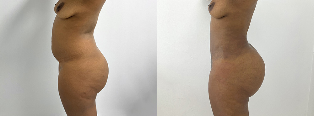 BBL Before and After