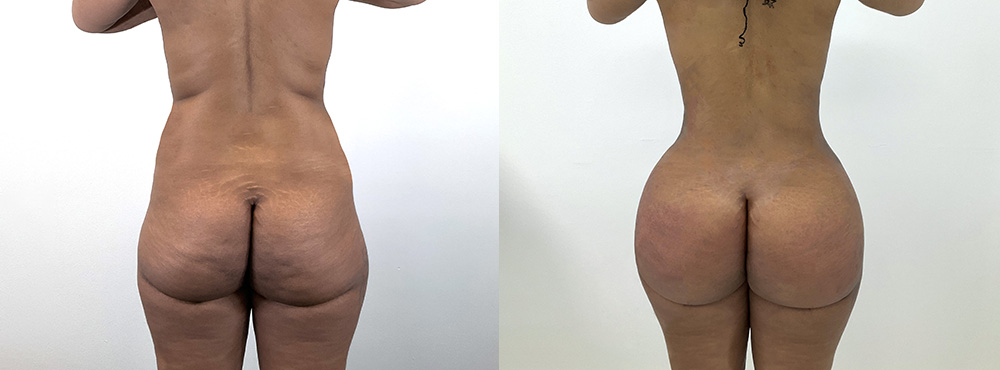 BBL Before and After