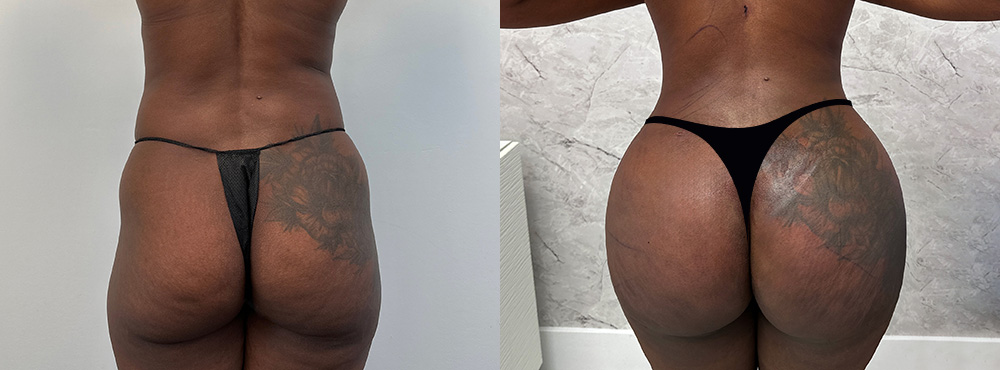Brazilian Butt Lift Before and After