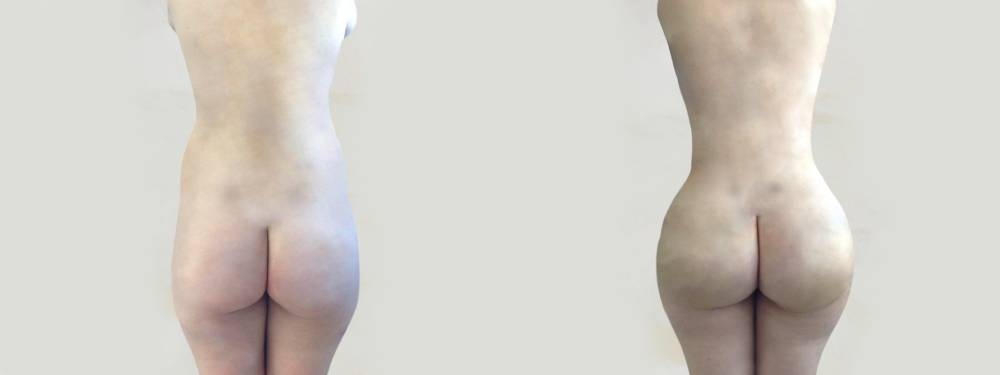 BBL before and after