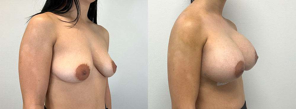 Breast Augmentation Before and After