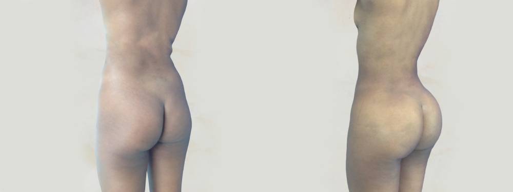 BBL before and after