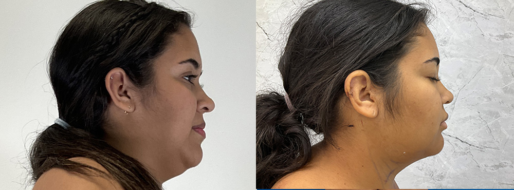 Chin lipo Before and After
