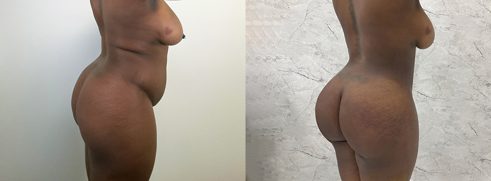 BBL Before and After