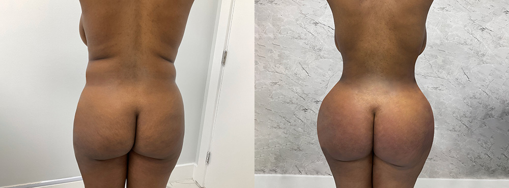 BBL Before and After