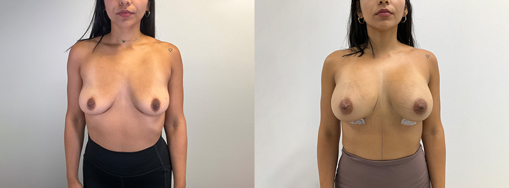 Breast Augmentation Before and After