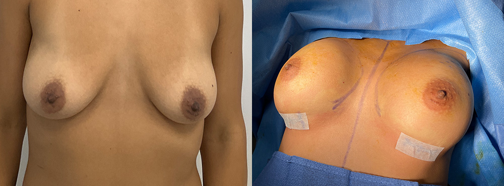 Breast Augmentation Before and After