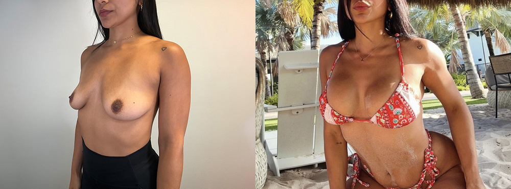 Breast Augmentation Before and After